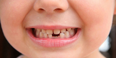 Brighton Kids Smile extractions