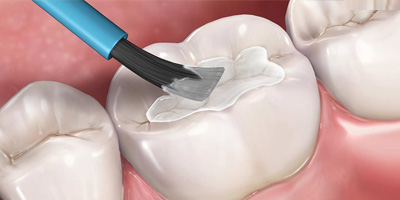 dental sealants